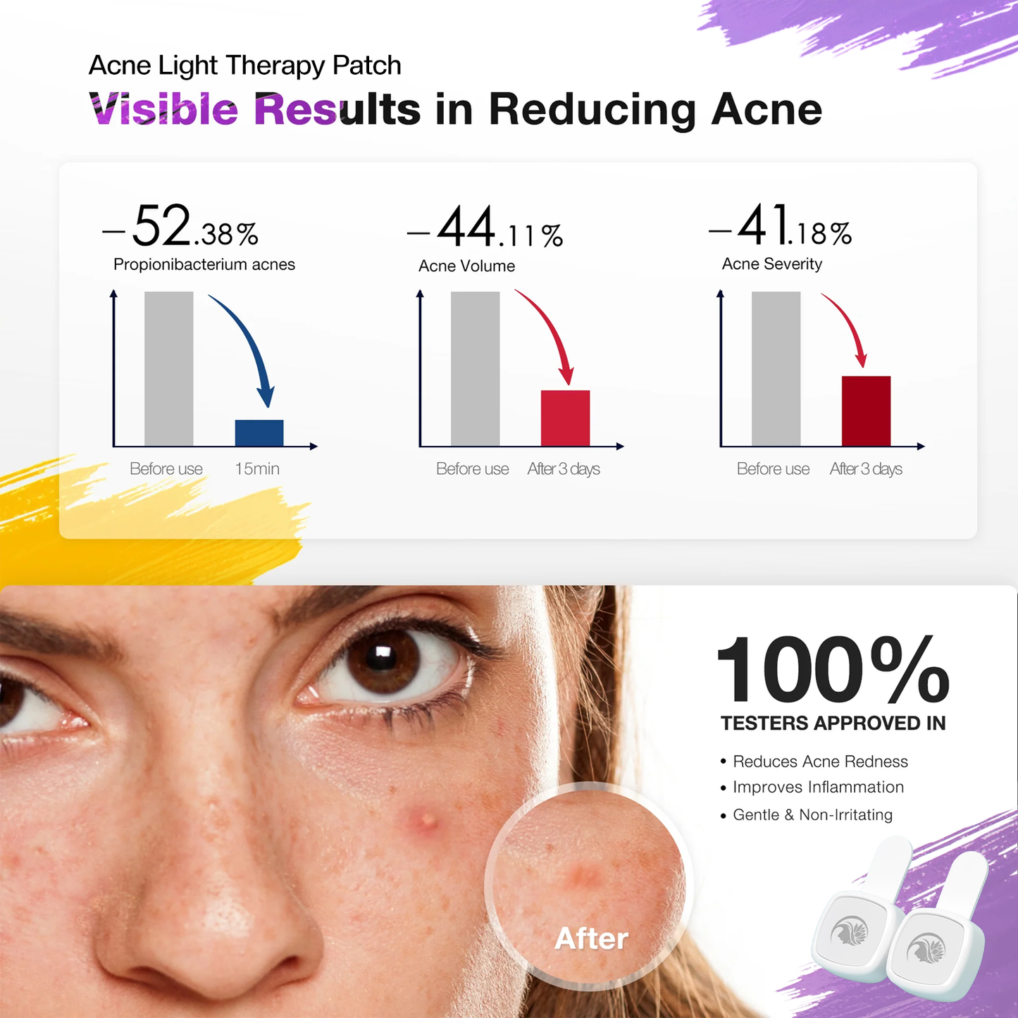 VivaGlam LED Therapy Acne Patch
